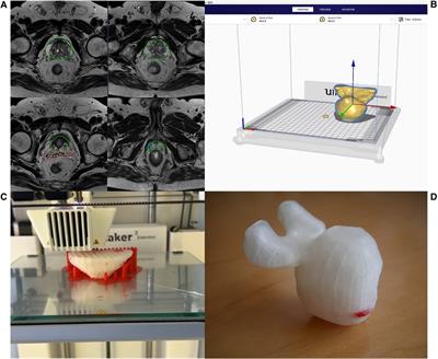 Understanding tumor localization in multiparametric MRI of the prostate—effectiveness of 3D printed models